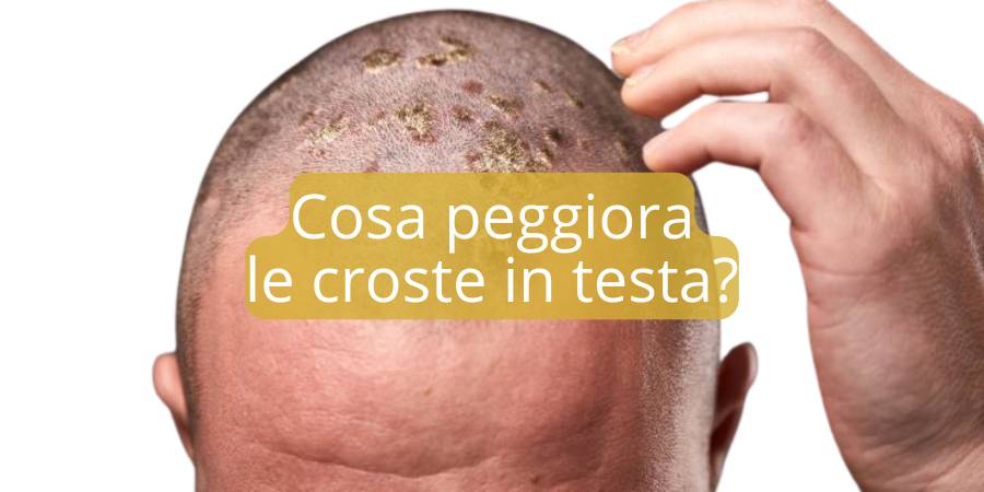 Cosa peggiora le croste in testa? Abitudini e fattori da evitare per un cuoio capelluto sano